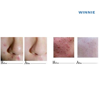 [winnie] crema de eliminación efectiva para acné, manchas, cicatrices, tratamiento de las estrías (4)