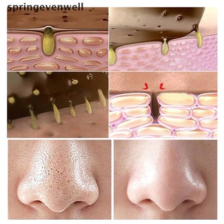 Evenwell Blackhead Remover Face Peel Mask Serum Shrink Pore Acne Treatment Skin Essence New Stock (2)