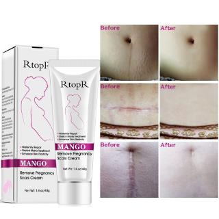 RtopR mango stretch marks and acne cream to remove stretch marks for pregnant women to repair anti-aging firming and firming