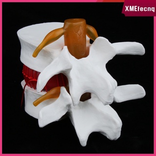 1:1.5 modelo de demostración de hernia de disco lumbar humano - columna vertebral lumbar, modelo de exhibición, ayuda educativa, blanco (5)