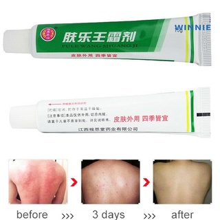 [winnie] fule wang shuangji piel psoriasis dermatitis eczema tratamiento ungüento (1)