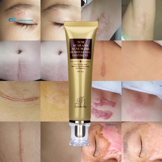 stock 30ml crema de eliminación de cicatrices tratamiento de acné puntos negros tratamiento facial blanqueamiento cuidado de la piel (3)