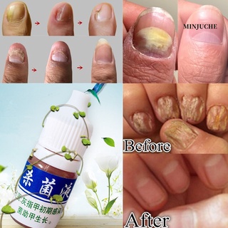 【minjuche】10ml Onychomycosis Nail Repair Treatment Liquid Cleanser Herbal Disinfect Serum