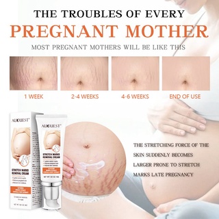 crema de eliminación de estrías de maternidad removedor de cicatrices para mujeres embarazadas
