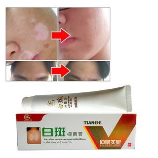 HM.Chinese Medical White Spot Disease crema pigmento melanina promoción Liniment piel Vitiligo Leukoplakia enfermedad Treatm