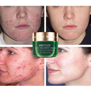 【Chiron】Acne Treatment Serum Facial Essence Anti Acne Scar Removal Cream (3)