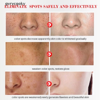 [gvrycqoky] crema de pecas blanqueadora efectiva eliminar pigmentación gel hidratante cuidado de la piel (1)