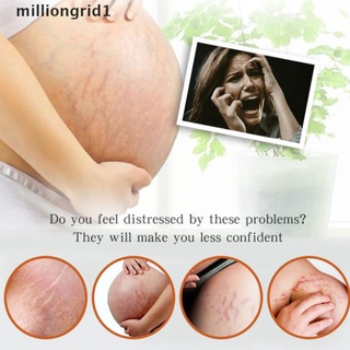 【milliongrid1】 AUQUEST Remove Pregnancy Scars Acne Cream Stretch Treatment Maternity Repair Hot (9)