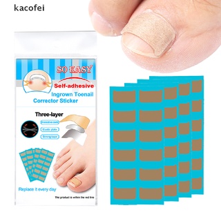 [kacofei] calcomanías correctoras de uñas encarnadas/corrector de uñas/herramienta de tratamiento de paroniquia