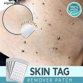 aigowarm removedor de etiquetas de piel parche ance parche de yeso crema de acné de absorción rápida cuidado de la cara co (1)