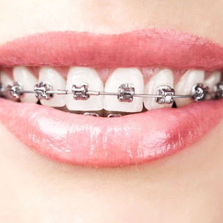 Mini Soporte De Cerámica De Metal Para Tratamiento De Ortodoncia Dental 022MBT 345 Ganchos (6)