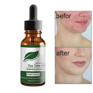 [jm] tratamiento de acné/aceite esencial de árbol de té hidratante de poros retráctiles/control de piel