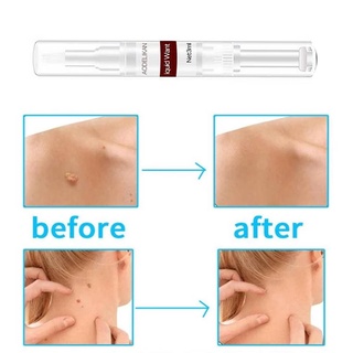 littlebeare.co 3ml Wart Treatment Pen Papillomas Removal Anti Verruca Gentle Advanced Ingredients Skin Tag Remover for Beauty (8)