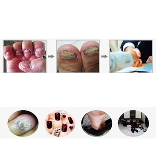 tratamiento de hongos en las uñas crema onicomicosis paroniquia antifúngica herbal (2)