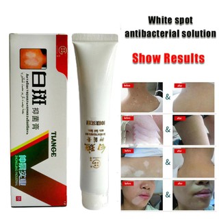 HM.Chinese Medical White Spot Disease crema pigmento melanina promoción Liniment piel Vitiligo Leukoplakia enfermedad Treatm (3)
