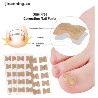 【jinanning】 10-60Pcs Ingrown Toenail Corrector Stickers Paronychia Treatment Pedicure Patch 【CO】