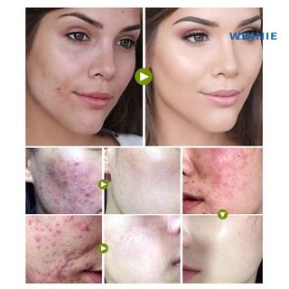 [winnie] breylee tratamiento del acné crema anti espinillas control de aceite de poros retráctiles gel reparador (7)