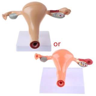 RA Human Pathological Uterus Ovary Model Anatomical Anatomy Disease Pathology Medical Lesion For Teaching
