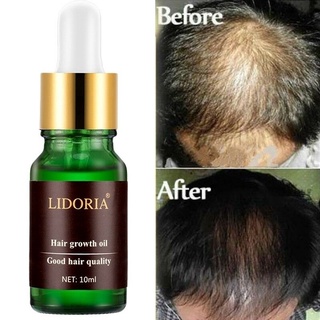 Anti Hair Loss Treatments Regrowth Natural Extract Oil Products for Men Women (1)