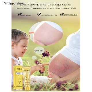 [nnhgghbyu] 1pc eliminar cicatrices de embarazo crema de reparación de la piel rosa eliminar las estrías crema venta caliente
